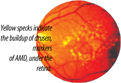 Eye, Retina, AMD